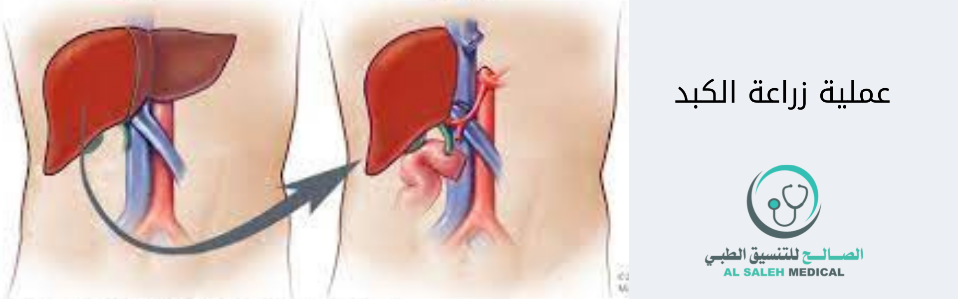  عملية زراعة الكبد في الهند | تكاليف مخفضة 